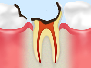 【C4：歯根に達した虫歯】